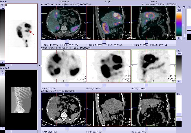 Obr. č. 16: Fúze obrazů SPECT a CT – vyšetření břicha. Vyšetření 24 hod. po aplikaci radiofarmaka. Vpravo nahoře fúze SPECT a CT, vlevo uprostřed SPECT, vlevo dole CT. Zaměřeno na ložisko v pravém jaterním laloku.