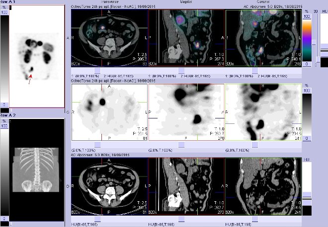 Obr. č. 16: Fúze obrazů SPECT a CT – vyšetření břicha. Vyšetření 24 hod. po aplikaci radiofarmaka. Vpravo nahoře fúze SPECT a CT, vlevo uprostřed SPECT, vlevo dole CT. Zaměřeno na ložisko v pravém mesogastriu.
