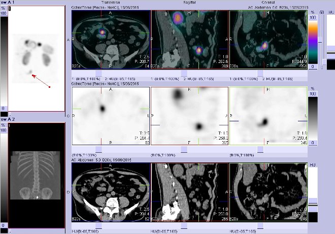 Obr. č. 6: Fúze obrazů SPECT a CT – vyšetření břicha. Vyšetření 4 hod. po aplikaci radiofarmaka. Vpravo nahoře fúze SPECT a CT, vlevo uprostřed SPECT, vlevo dole CT. Zaměřeno na ložisko v pravém mesogastriu.
