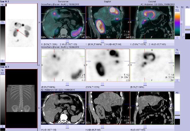 Obr. č. 7: Fúze obrazů SPECT a CT – vyšetření břicha. Vyšetření 4 hod. po aplikaci radiofarmaka. Vpravo nahoře fúze SPECT a CT, vlevo uprostřed SPECT, vlevo dole CT. Zaměřeno na ložisko v pravém jaterním laloku.