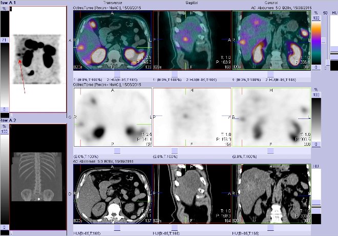 Obr. č. 8: Fúze obrazů SPECT a CT – vyšetření břicha. Vyšetření 4 hod. po aplikaci radiofarmaka. Vpravo nahoře fúze SPECT a CT, vlevo uprostřed SPECT, vlevo dole CT. Zaměřeno na ložisko v pravém jaterním laloku.