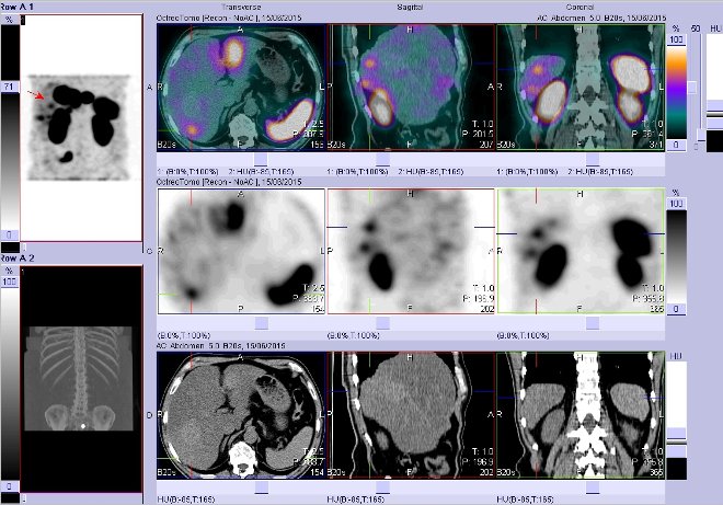 Obr. č. 9: Fúze obrazů SPECT a CT – vyšetření břicha. Vyšetření 4 hod. po aplikaci radiofarmaka. Vpravo nahoře fúze SPECT a CT, vlevo uprostřed SPECT, vlevo dole CT. Zaměřeno na ložisko v pravém jaterním laloku.