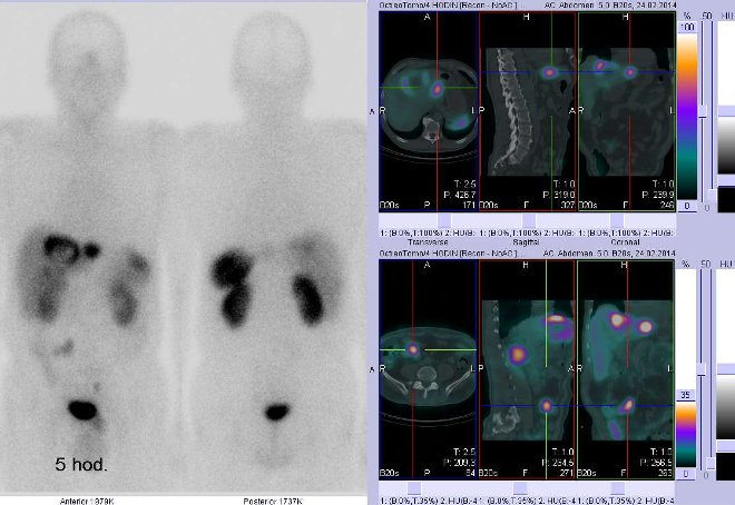 Obr.1: Celotělová scintigrafie v přední a zadní projekci a fúze obrazů SPECT a CT. Vyšetření 5 hod. po aplikaci radioindikátoru. Vpravo nahoře zaměřeno na ložisko v levém jaterním laloku, vpravo dole zaměřeno na ložisko v pravém mesogastriu.