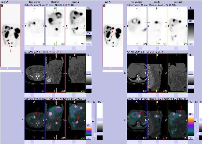 Obr.3: Fúze obrazů SPECT a CT – vyšetření břicha. Vyšetření 24 hod. po aplikaci radiofarmaka. Vlevo nahoře SPECT, vlevo uprostřed CT, vlevo dole fúze obrazů, zaměřeno na ložisko v pravém mesogastriu. Vpravo nahoře SPECT, vpravo uprostřed CT, vpravo dole fúze obrazů, zaměřeno na ložisko v levém jaterním laloku.