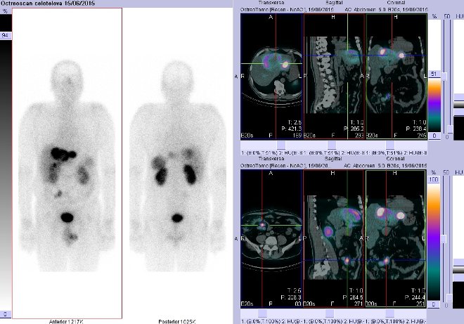 Obr. č. 4: Celotělová scintigrafie v přední a zadní projekci a fúze obrazů SPECT a CT. Vyšetření 4 hod. po aplikaci radioindikátoru. Vpravo nahoře zaměřeno na ložisko v pravém jaterním laloku, vpravo dole zaměřeno na ložisko v pravém mesogastriu.