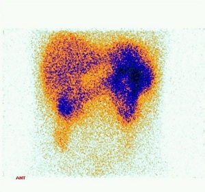 Obrázek č. 3 - Statická scintigrafie břicha za 22 hodin po i.v. aplikaci 110 MBq In-111 OcteoScanu. Přední projekce.