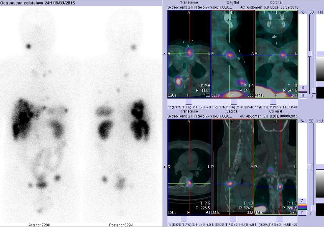 Obr.č.4: Celotělová scintigrafie v přední a zadní projekci a fúze obrazů SPECT a CT. Vyšetření 24 hod. po aplikaci radioindikátoru. Zaměřeno na ložisko v levém sternoklavikulárním skloubení a hrudním obratli.