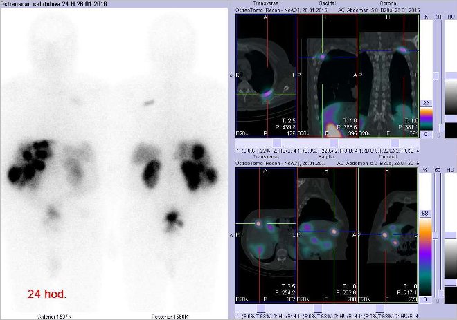 Obr. č. 5: Celotělová scintigrafie a fúze obrazů SPECT a CT. Vpravo nahoře zaměřeno na ložisko v dorzální části 4. žebra vlevo a vpravo dole na ložisko ve ventrální části pravého jaterního laloku. Řez transverzální, sagitální a koronární. Vyšetření 24 hod. po aplikaci OctreoScanu.