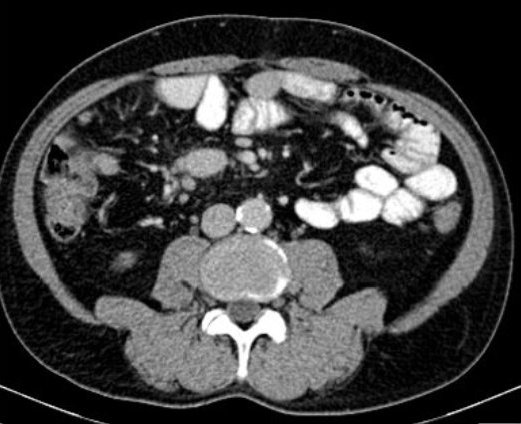 Obr. č. 3: CT břicha.