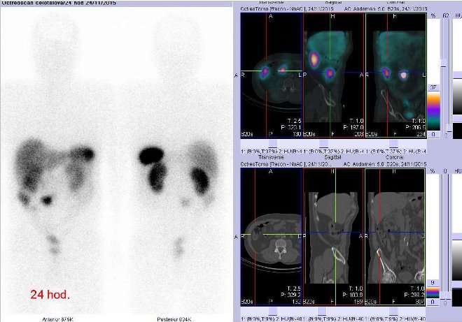 Obr. č. 5: Celotělová scintigrafie a fúze obrazů SPECT a CT. Vyšetření 24 hod. po aplikaci radioindikátoru. Vpravo nahoře fúze obrazů SPECT a CT, vpravo dole CT – vždy zaměřeno na ložisko v pravém mesogastriu laterálně ve vzestupném tračníku- nejedná se o patologický nález, vždy vlevo transverzální řezy, uprostřed sagitální řezy, vpravo řezy koronární.