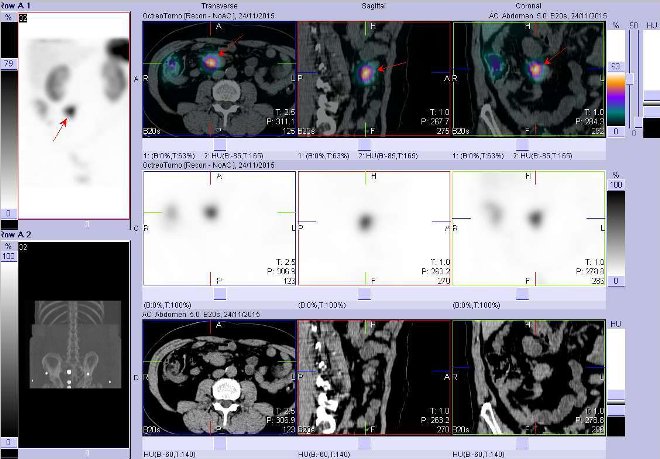 Obr. č. 6: SPECT, CT a fúze obrazů SPECT a CT. Vyšetření 24 hod. po aplikaci radioindikátoru. Nahoře fúze obrazů, uprostřed obrazy SPECT, dole obrazy CT, vždy vlevo transverzální  řezy, uprostřed sagitální řezy, vpravo řezy koronární. Zaměřeno na ložisko v břiše v pravém mesogastriu.