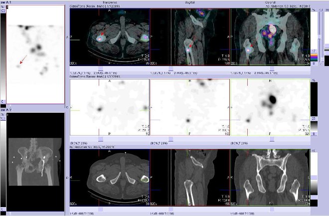 Obr. č. 10: Fúze obrazů SPECT a CT. Vyšetření 24 hod. po aplikaci radiofarmaka. Nahoře fúze obrazů, uprostřed SPECT, dole CT. Vždy nad sebou: vlevo transverzální řezy, uprostřed sagitální řezy, vpravo koronární. Zaměřeno na ložisko v pravé stehenní kosti.