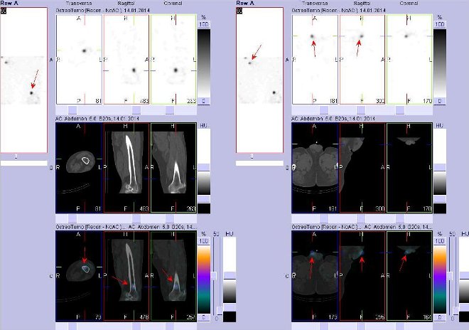 Obr. č. 3: Fúze obrazů SPECT a CT – vlevo levá stehenní kost, vpravo dolní části břicha. Vyšetření 24 hod. po aplikaci radiofarmaka. Nahoře SPECT, uprostřed CT, dole fúze obrazů. Vždy nad sebou: vlevo transverzální řezy, uprostřed sagitální řezy, vpravo koronární. Zaměřeno na ložisko v distální části  levé stehenní kosti, vpravo zaměřeno na ložisko aktivity podmíněné kontaminací.