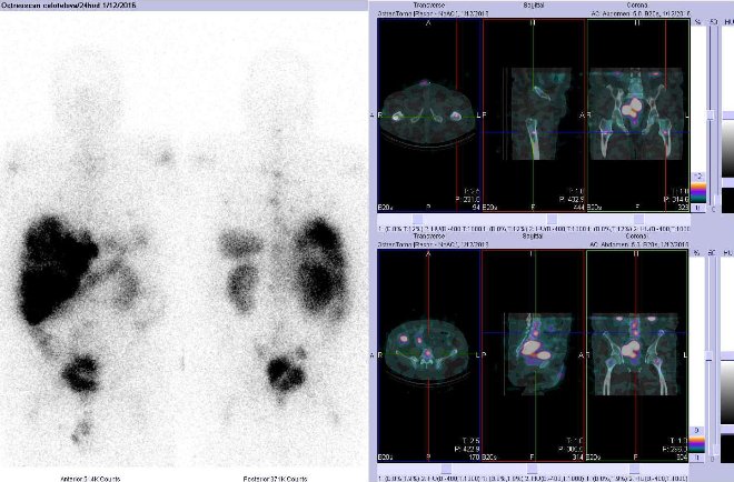 Obr. č. 7: Celotělová scintigrafie v přední a zadní projekci a fúze obrazů SPECT/CT. Vpravo nahoře zaměřeno na ložisko v levé stehenní kosti a vpravo dole na ložisko v bederním obratli. Vyšetření 24 hod. po aplikaci radioindikátoru.