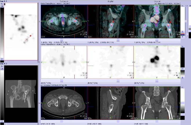 Obr. č. 8: Fúze obrazů SPECT a CT. Vyšetření 24 hod. po aplikaci radiofarmaka. Nahoře fúze obrazů, uprostřed SPECT, dole CT. Vždy nad sebou: vlevo transverzální řezy, uprostřed sagitální řezy, vpravo koronární. Zaměřeno na ložisko v levé stehenní kosti.