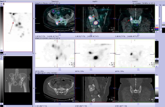 Obr. č. 9: Fúze obrazů SPECT a CT – zaměřeno na ložisko v pánvi vpravo. Vyšetření 24 hod. po aplikaci radiofarmaka. Nahoře fúze obrazů, uprostřed SPECT, dole CT. Vždy nad sebou: vlevo transverzální řezy, uprostřed sagitální řezy, vpravo koronární.