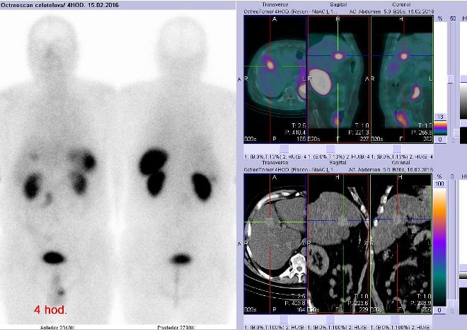 Obr. č. 2: Celotělová scintigrafie v přední a zadní projekci a fúze SPECT/CT 4 hod. po aplikaci OctreoScanu. Zaměřeno na ložisko ve ventrální části pravého jaterního laloku.