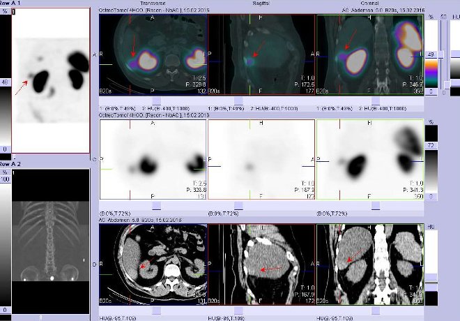 Obr. č. 3: Fúze obrazů SPECT a CT. Zaměřeno na ložisko v dorzální části pravého jaterního laloku. Řez transverzální, sagitální a koronární. Nahoře fúze obrazů, uprostřed SPECT, dole CT. Vyšetření 4 hod. po aplikaci OctreoScanu.