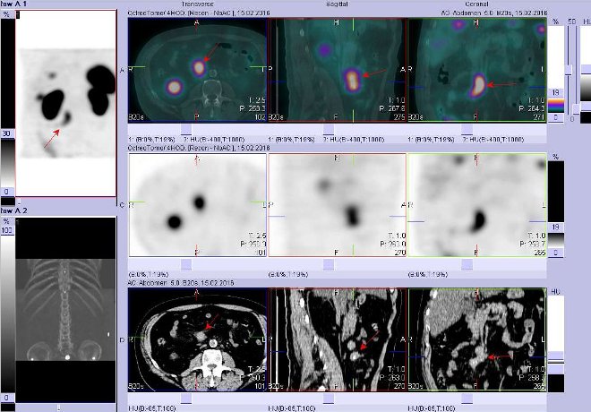 Obr. č. 5: Fúze obrazů SPECT a CT. Zaměřeno na ložisko v pravé části břicha buď v uzlině nebo ve střevě. Řez transverzální, sagitální a koronární. Nahoře fúze obrazů, uprostřed SPECT, dole CT. Vyšetření 4 hod. po aplikaci OctreoScanu.