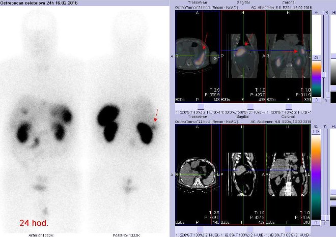 Obr. č. 6: Celotělová scintigrafie v přední a zadní projekci a fúze SPECT/CT 24 hod. po aplikaci OctreoScanu. Zaměřeno na ložisko – část tkáně sleziny. Není to patologický nález.