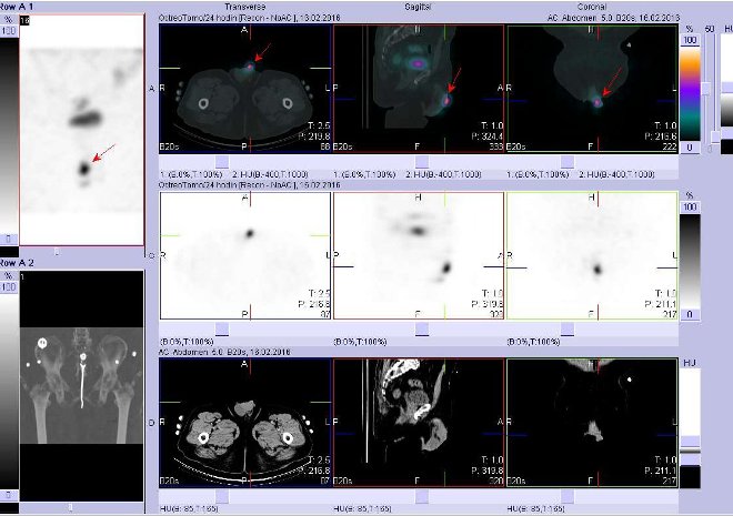 Obr. č. 7: Fúze obrazů SPECT a CT. Zaměřeno na okrsek kontaminace. Nahoře fúze obrazů, uprostřed SPECT, dole CT. Vyšetření 24 hod. po aplikaci OctreoScanu.
