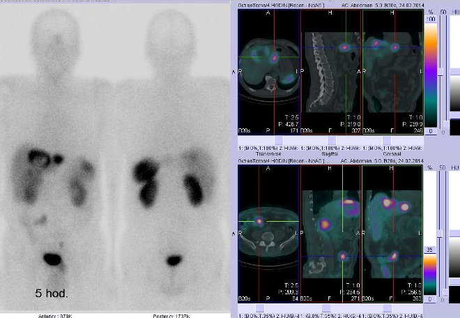 Obr.č. 1: Celotělová scintigrafie v přední a zadní projekci a fúze obrazů SPECT a CT. Vyšetření 5 hod. po aplikaci radioindikátoru. Vpravo nahoře zaměřeno na ložisko v levém jaterním laloku, vpravo dole zaměřeno na ložisko v pravém mesogastriu.