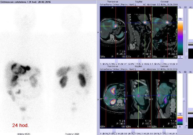 Obr. č. 10: Celotělová scintigrafie v přední a zadní projekci a fúze obrazů SPECT a CT. Vyšetření 24 hod. po aplikaci radioindikátoru. Vpravo nahoře zaměřeno na ložisko v levém jaterním laloku, vpravo dole zaměřeno na ložisko v pravém jaterním laloku.