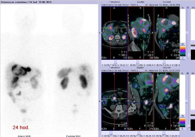 Obr. č. 11: Celotělová scintigrafie v přední a zadní projekci a fúze obrazů SPECT a CT. Vyšetření 24 hod. po aplikaci radioindikátoru. Vpravo nahoře zaměřeno na ložisko v pravém jaterním laloku, vpravo dole zaměřeno na ložisko v pravém mesogastriu.