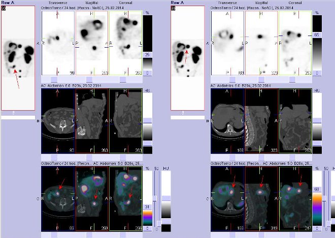 Obr. č. 2: Fúze obrazů SPECT a CT – vyšetření břicha. Vyšetření 24 hod. po aplikaci radiofarmaka. Vlevo nahoře SPECT, vlevo uprostřed CT, vlevo dole fúze obrazů, zaměřeno na ložisko v pravém mesogastriu. Vpravo nahoře SPECT, vpravo uprostřed CT, vpravo dole fúze obrazů, zaměřeno na ložisko v levém jaterním laloku.