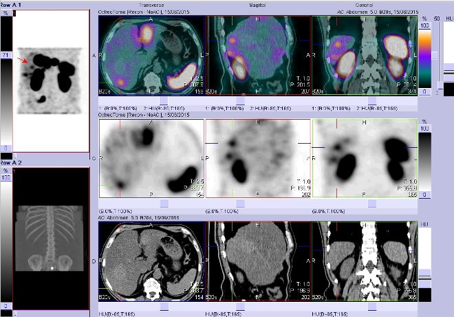 Obr. č. 4: Fúze obrazů SPECT a CT – vyšetření břicha. Vyšetření 4 hod. po aplikaci radiofarmaka. Vpravo nahoře fúze SPECT a CT, vlevo uprostřed SPECT, vlevo dole CT. Zaměřeno na ložisko v pravém jaterním laloku.