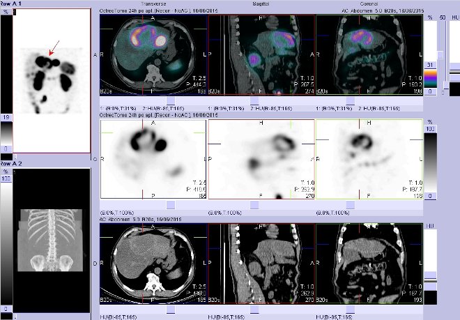 Obr. č. 6: Fúze obrazů SPECT a CT – vyšetření břicha. Vyšetření 24 hod. po aplikaci radiofarmaka. Vpravo nahoře fúze SPECT a CT, vlevo uprostřed SPECT, vlevo dole CT. Zaměřeno na ložisko v pravém jaterním laloku.