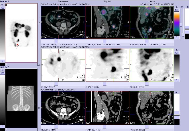 Obr. č. 8: Fúze obrazů SPECT a CT – vyšetření břicha. Vyšetření 24 hod. po aplikaci radiofarmaka. Vpravo nahoře fúze SPECT a CT, vlevo uprostřed SPECT, vlevo dole CT. Zaměřeno na ložisko v pravém mesogastriu.