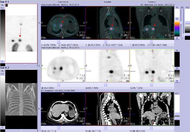 Obr.3: Fúze obrazů SPECT a CT. Zaměřeno na ložisko v dorzomediální části pravého jaterního laloku. Vyšetření 4 hod. po aplikaci radioindikátoru.