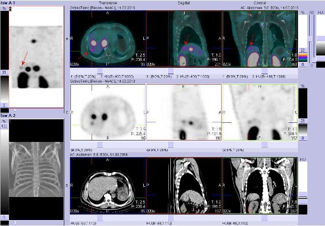 Obr. č. 4: Fúze obrazů SPECT a CT. Zaměřeno na ložisko v dorzolaterální části pravého jaterního laloku. Vyšetření 4 hod. po aplikaci radioindikátoru.