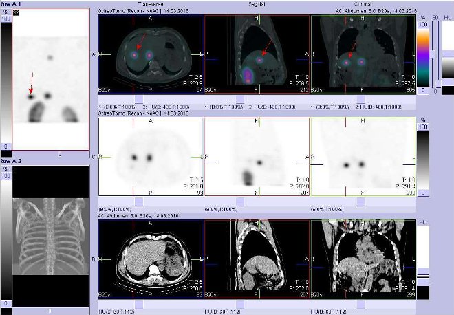 Obr. č. 5: Fúze obrazů SPECT a CT. Zaměřeno na ložisko v laterální části pravého jaterního laloku. Vyšetření 4 hod. po aplikaci radioindikátoru.