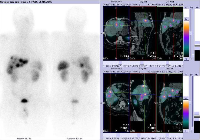 Obr.č.1: Celotělová scintigrafie v přední a zadní projekci a fúze SPECT/CT břicha a pánve 5 hod. po aplikaci OctreoScanu. Zaměřeno na ložiska v játrech.