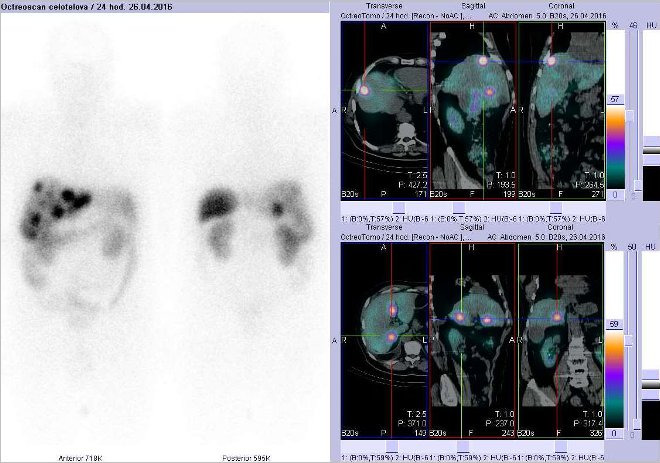 Obr. č. 2: Celotělová scintigrafie v přední a zadní projekci a fúze SPECT/CT břicha a pánve 24 hod. po aplikaci OctreoScanu. Zaměřeno na ložiska v játrech.