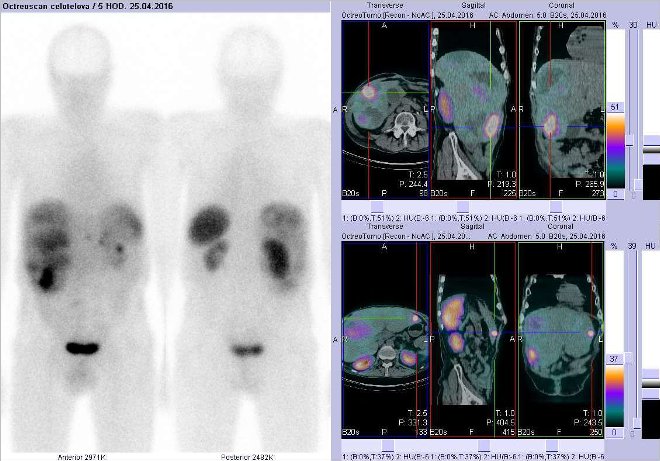 Obr. č. 1: Celotělová scintigrafie v přední a zadní projekci a fúze SPECT/CT 5 hod. po aplikaci OctreoScanu. Zaměřeno na ložiska v pravém a levém jaterním laloku.
