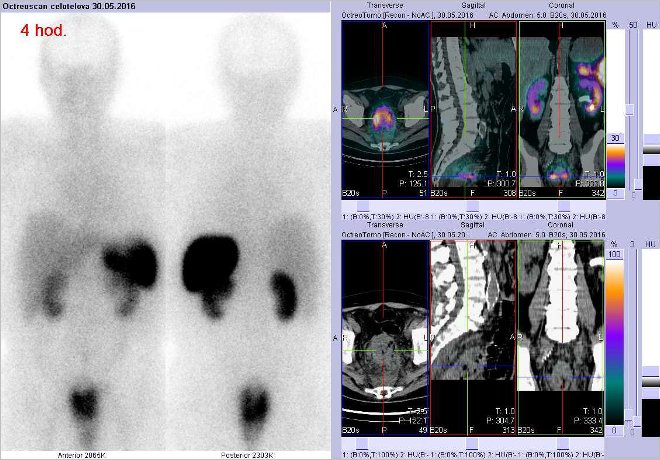 Obr.č.1: Celotělová scintigrafie v přední a zadní projekci a fúze obrazů SPECT a CT. Zaměřeno na  patologické ložisko v oblasti rekta. Vyšetření 4 hod. po aplikaci radioindikátoru.