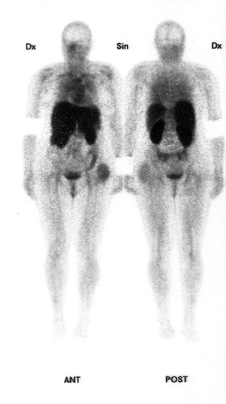 Obrázek č.2: Celotělový scan po i. v. aplikaci 99mTc sulesomabu (LeukoScan)