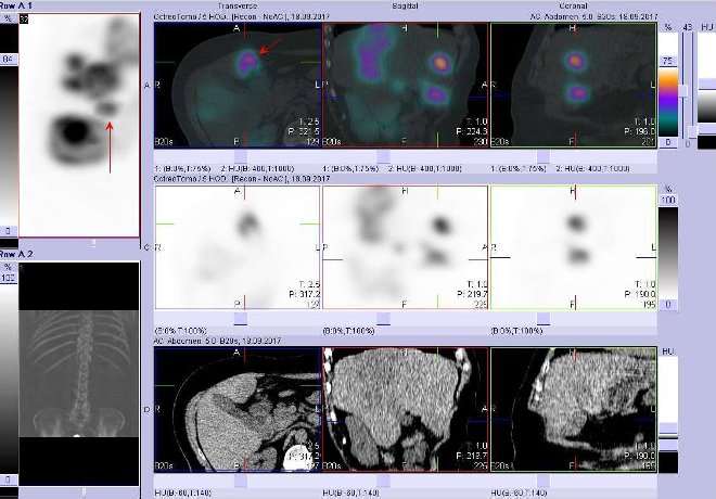 Obr. č. 6: Fúze obrazů SPECT a CT. Vyšetření 5 hod. po aplikaci radioindikátoru. Zaměřeno na ložisko ve ventrokaudální části pravého jaterního laloku.