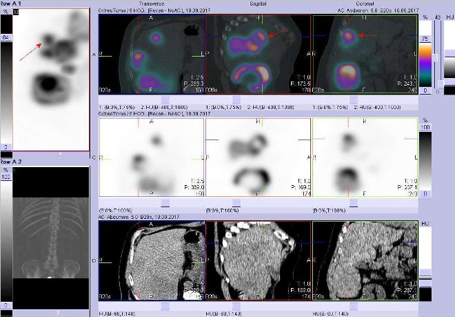Obr. č. 7: Fúze obrazů SPECT a CT. Vyšetření 5 hod. po aplikaci radioindikátoru. Zaměřeno na ložisko v laterální části pravého jaterního laloku.