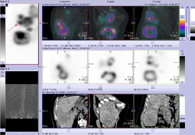 Obr. č. 8: Fúze obrazů SPECT a CT. Vyšetření 5 hod. po aplikaci radioindikátoru. Zaměřeno na ložisko v laterální části pravého jaterního laloku.