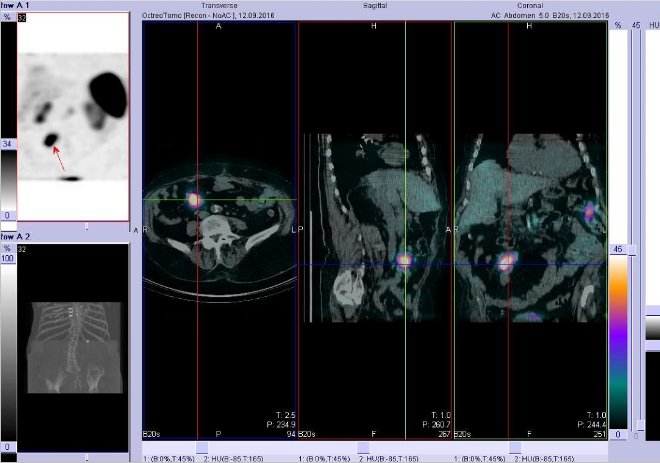 Obr.č.2: Fúze obrazů SPECT a CT – vyšetření břicha. Vyšetření 4 hod. po aplikaci radiofarmaka. Vlevo transverzální řez, uprostřed sagitální řez, vpravo koronární. Zaměřeno na ložisko v pravém mesogastriu.