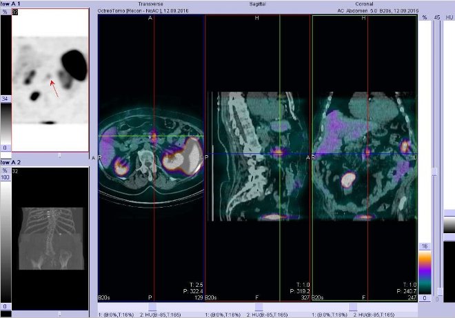 Obr.3: Fúze obrazů SPECT a CT – vyšetření břicha. Vyšetření 4 hod. po aplikaci radiofarmaka. Vlevo řez  transverzální, uprostřed sagitální, vpravo koronární. Zaměřeno na ložisko v epigastriu.