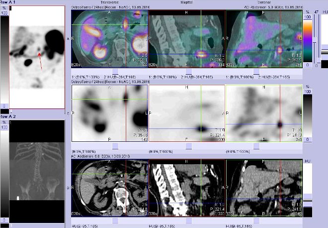 Obr. č. 5: Fúze obrazů SPECT a CT – vyšetření břicha. Vyšetření 24 hod. po aplikaci radiofarmaka. Nahoře fúze obrazů, uprostřed SPECT, dole CT. Vždy nad sebou: vlevo transverzální řezy, uprostřed sagitální řezy, vpravo koronární. Zaměřeno na ložisko v epigastriu.