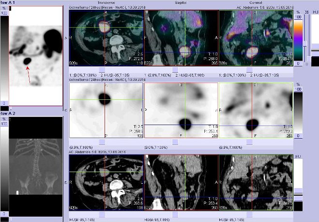 Obr. č. 6: Fúze obrazů SPECT a CT – vyšetření břicha. Vyšetření 24 hod. po aplikaci radiofarmaka. Nahoře fúze obrazů, uprostřed SPECT, dole CT. Vždy nad sebou: vlevo transverzální řezy, uprostřed sagitální řezy, vpravo koronární. Zaměřeno na ložisko v pravém mesogastriu.