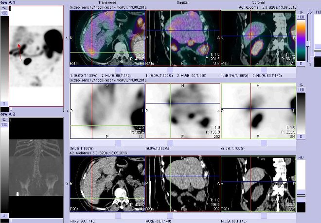 Obr. č. 7: Fúze obrazů SPECT a CT – vyšetření břicha. Vyšetření 24 hod. po aplikaci radiofarmaka. Nahoře fúze obrazů, uprostřed SPECT, dole CT. Vždy nad sebou: vlevo transverzální řezy, uprostřed sagitální řezy, vpravo koronární. Zaměřeno na ložisko v pravém jaterním laloku.