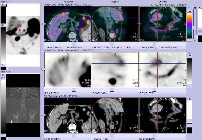 Obr. č. 8: Fúze obrazů SPECT a CT – vyšetření břicha. Vyšetření 24 hod. po aplikaci radiofarmaka. Nahoře fúze obrazů, uprostřed SPECT, dole CT. Vždy nad sebou: vlevo transverzální řezy, uprostřed sagitální řezy, vpravo koronární. Zaměřeno na ložisko v levém jaterním laloku.