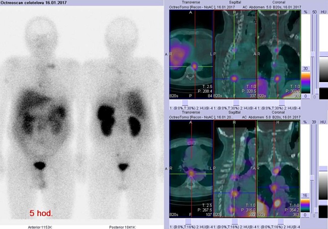 Obr. č. 1: Celotělová scintigrafie v přední a zadní projekci a fúze obrazů SPECT a CT. Vyšetření 5 hod. po aplikaci radioindikátoru